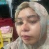Wanita di Marikurubu Dipukul Paman Gara-Gara Sengketa Tanah, Hidung Pecah di Tempat