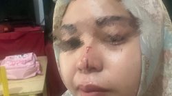 Wanita di Marikurubu Dipukul Paman Gara-Gara Sengketa Tanah, Hidung Pecah di Tempat